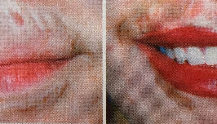 cleft lip-2